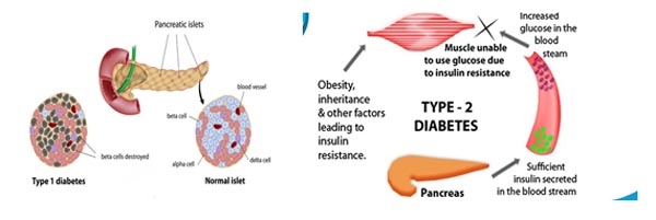 Types of Diabetes Mellitus