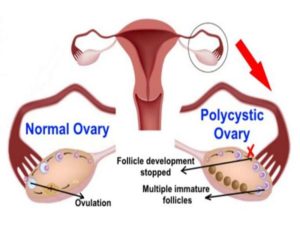 yoga for pcos infertility 3