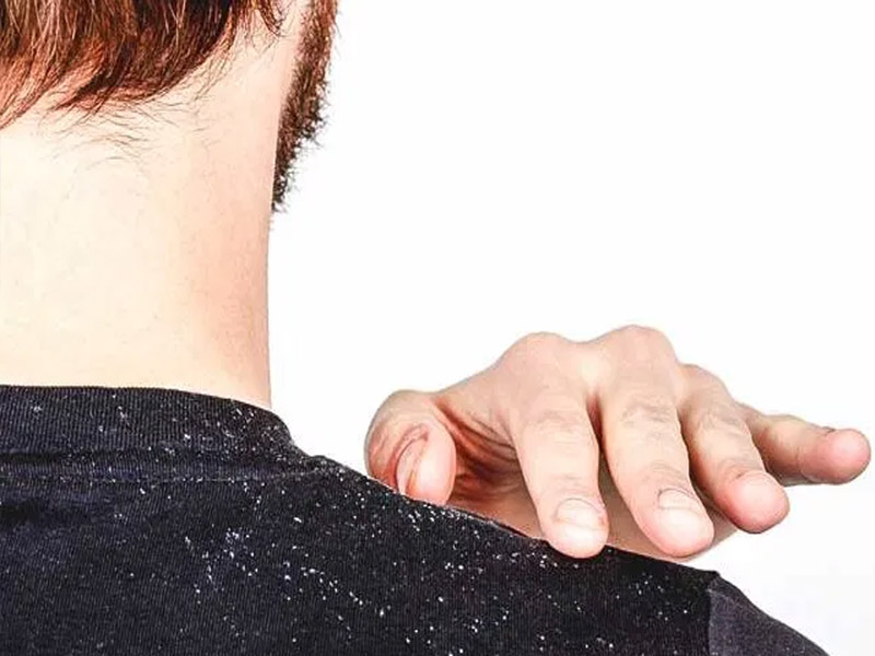 Home Remedies for Dandruff