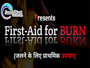 First Aid for Burns 1