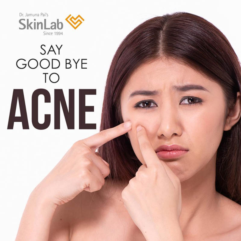 causes of Adult Acne