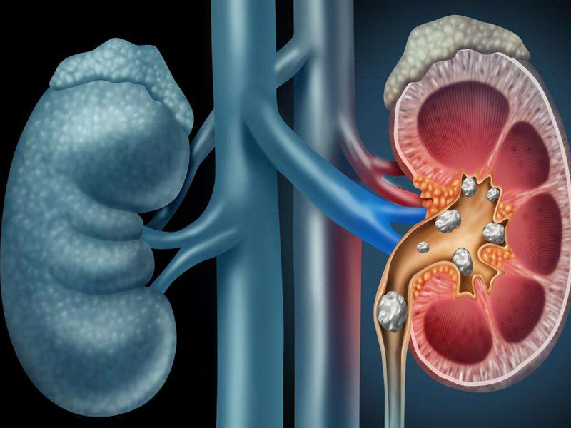 how Kidney stones formed