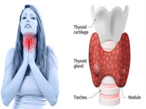 Naturopathy and Yogic Treatment of Thyroid