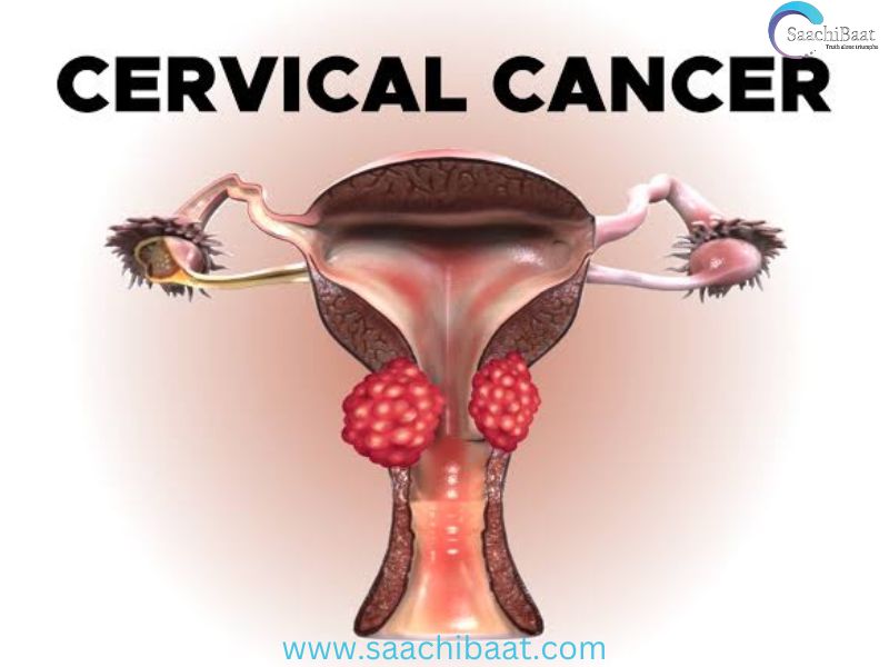 Cervical Cancer