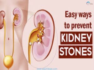 kidney stone