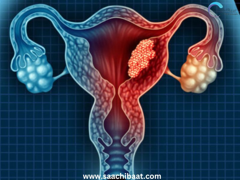 Uterine Cancer