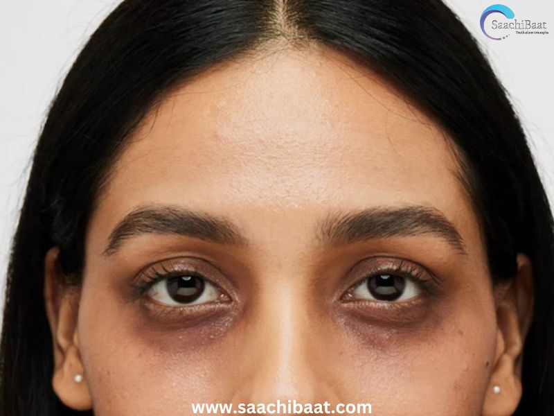 dark circles