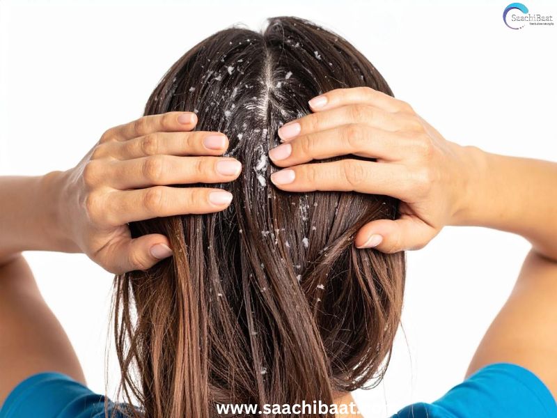 Removing dandruff