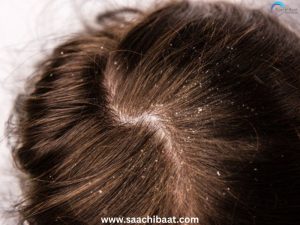 DANDRUFF CAUSES
