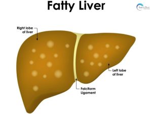 Fatty liver