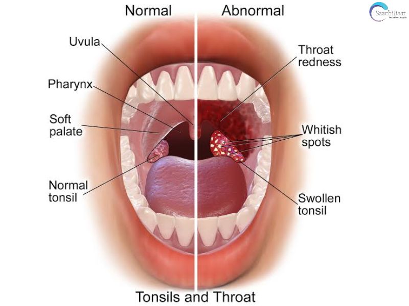TONSILLITIS