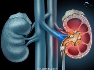 Interesting Facts - 10 July 2026 7 kidney stone
