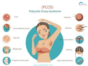 PCOS