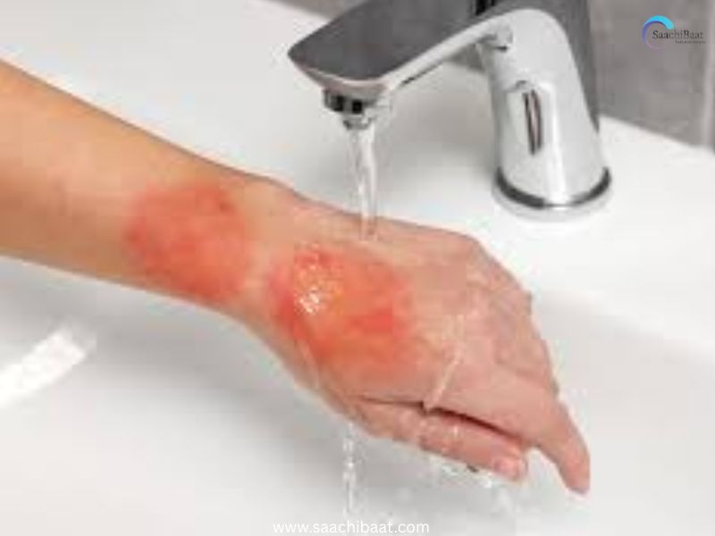 Wound Pain